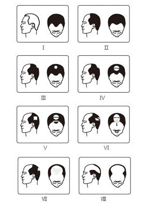Servicio tecnico láser capilar para el tratamiento de la alopecia
